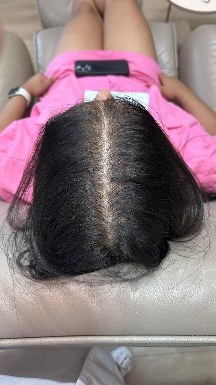 Depois, couro cabeludo com rarefação na coroa recuperando densidade