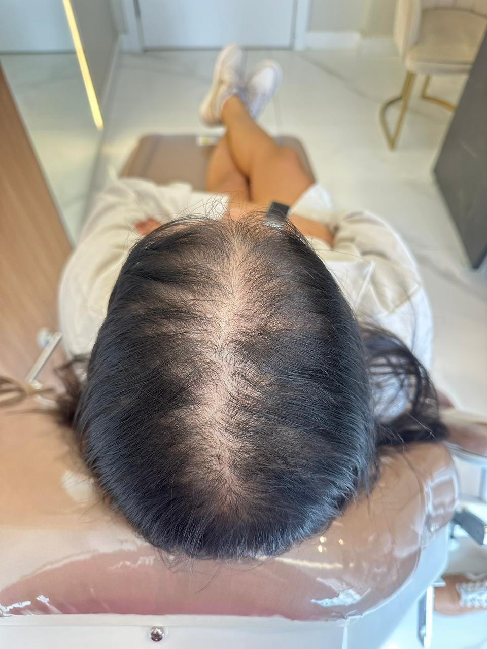 Antes, couro cabeludo com rarefação na coroa recuperando densidade