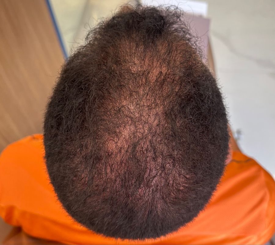 Antes, Alopecia androgenética