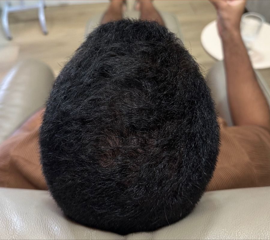 Depois, Alopecia androgenética